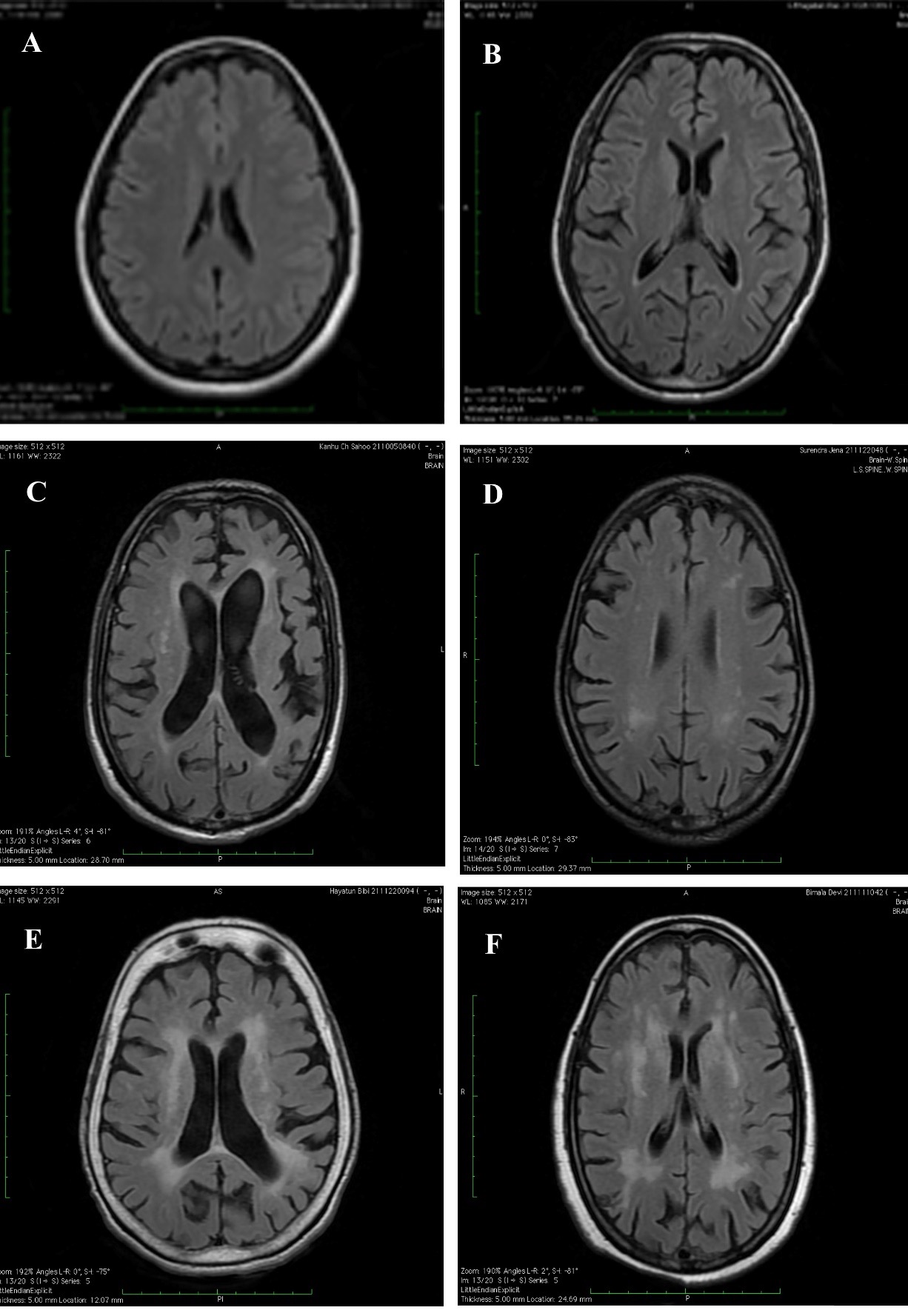 Frontiers  Fully Automatic Classification of Brain Atrophy on NCCT Images  in Cerebral Small Vessel Disease: A Pilot Study Using Deep Learning Models