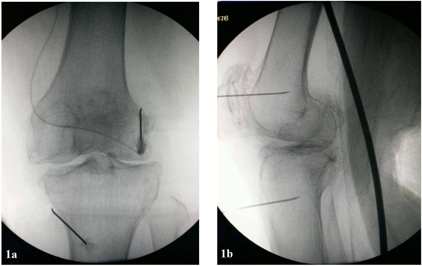 Fluoroscopic guidance imaging of (1a) antero-posterior and (1b) lateral views of the knee joint demonstrated the position of the radiofrequency cannula at superior lateral and inferior medial genicular nerves.