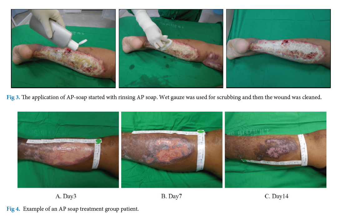 Example of an AP soap treatment group patient