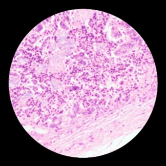 [TJS 46-3 04] Figure 5 Histopathological evaluation showing feature of tailgut cyst with mucinous adenocarcinomat protocol