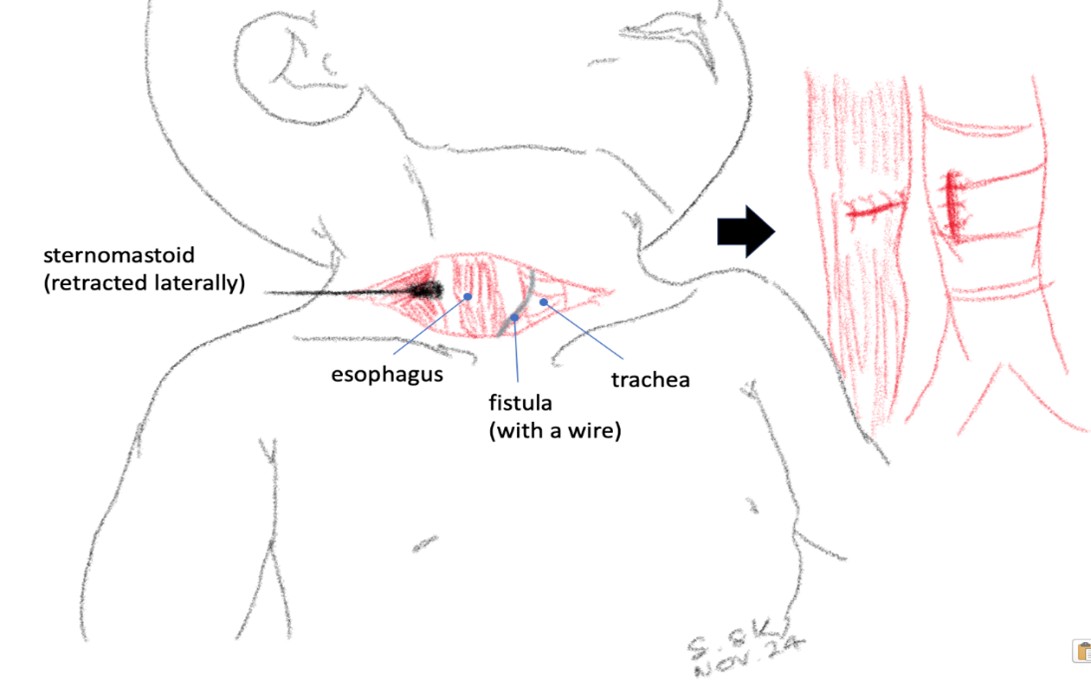 [TJS 46-3 05] Figure 3 Drawing pictures explaining the surgical anatomy of this patient. Through a transverse incision on the right neck above the clavicle, the esophagus was identified by retracting the right sternomastoid to the lateral side. The fistula could be identified by palpating the wire passed from the trachea to the esophagus. Note that the suture lines on the trachea and the esophagus were not in the exact alignment, which reduced the chance of recurrence.