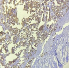 [TJS 46-3 06] Figure 3 Chromogranin A (CgA) positive tumor cells invading the submucosa × 100
