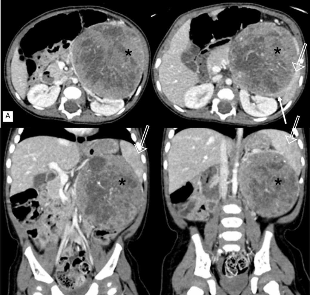 [TJS 46-4 06] Figure 1 Computerized tomography scan of the whole abdomen and coronal view. There was a mass effect to posteriorly displace pancreatic body and tail, laterally displace spleen with perfusion abnormality.