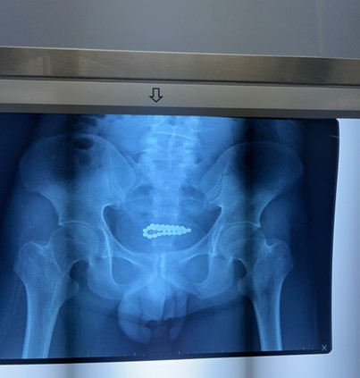 [TJS 46-4 05] Figure 1 An anterior-posterior pelvic X-ray showed a cluster of radio-opaque shadows in the pelvic region, with the shape consistent with magnetic beads