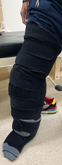 [TJS 46-4 02] Figure 1 A patient wearing customized pressure devices (Compreflex)