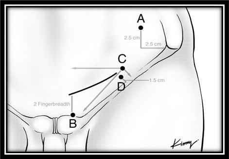 [TJS 47-1 04] Figure 1 Anesthetic infiltration site