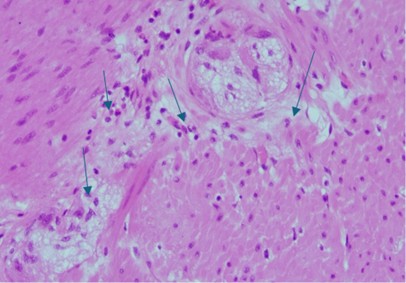 [TJS 47-1 06] Figure 4 The histological examination of the specimen highlights the features of hypoganglionosis with a reduced number of ganglionic cells