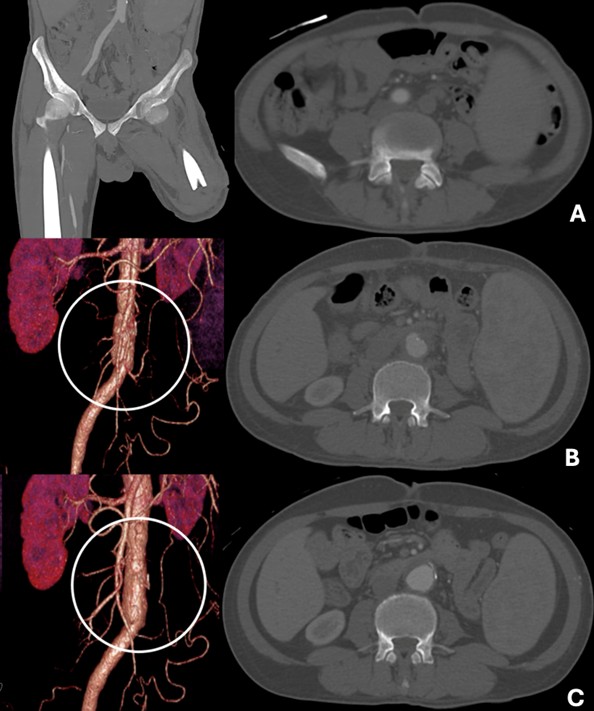 [TJS 47-1 07] Figure 3 Preoperative CTA showed total occlusion of the left CIA, IIA, and EIA down to the proximal SFA