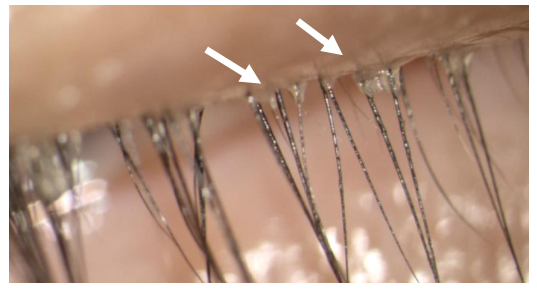 Cylindrical dandruff at the eyelash root