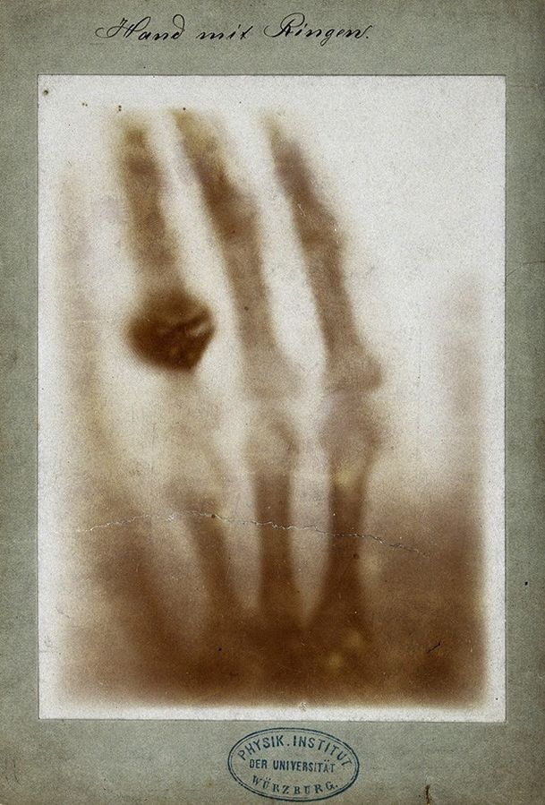 First medical X-ray by Wilhelm Röntgen of his wife Anna Bertha Ludwig's