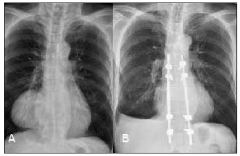Pre and Post operative chest X-ray showed a large mediastinal mass