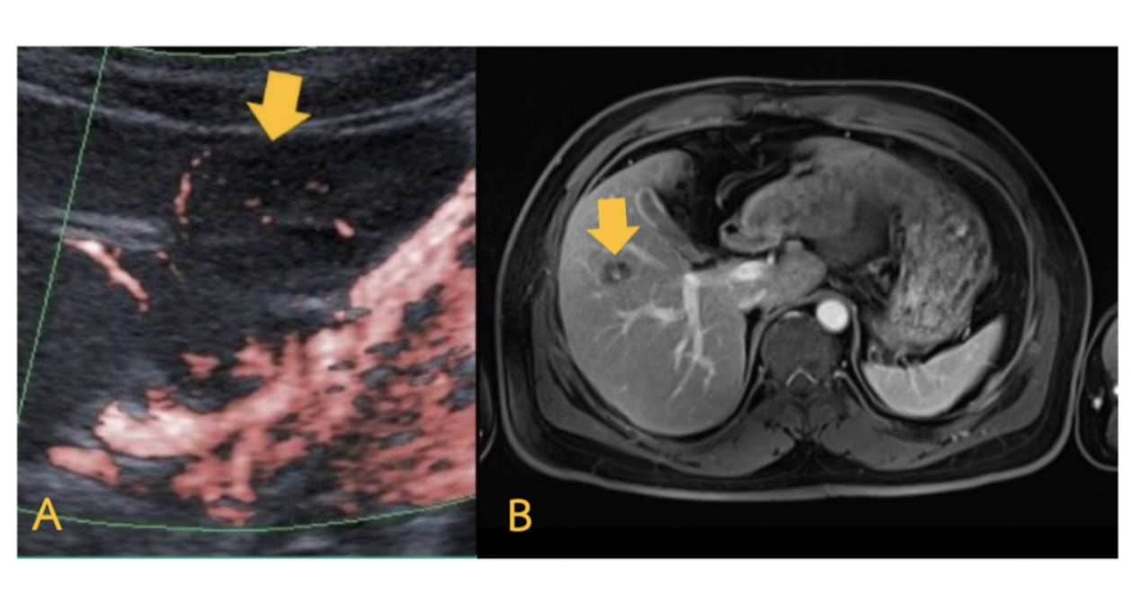 Differentiation Of Vascular Patterns In Hepatic Hemangioma Using Superb Microvascular Imaging